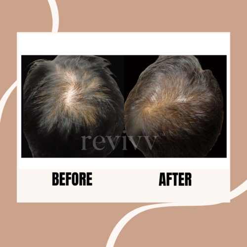 After using Revivv® for 2 months