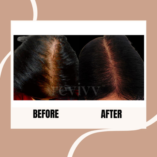 After using Revivv® for 2 months