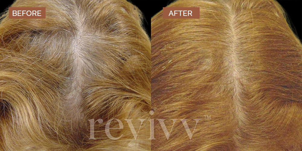 revivv for her before and after