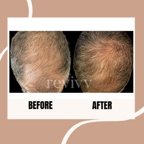 After using Revivv® for 2 months