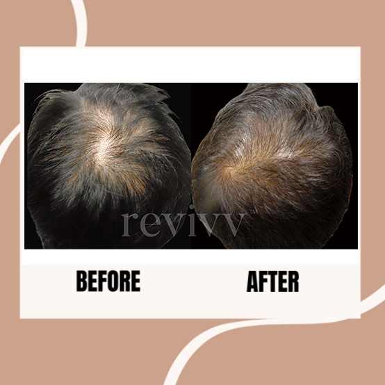 After using Revivv® for 2 months